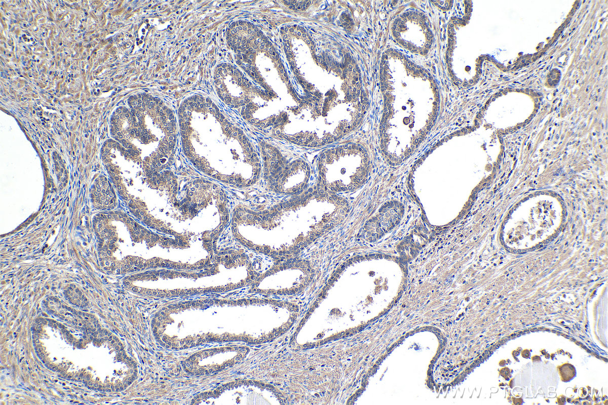 Immunohistochemical analysis of paraffin-embedded human prostate cancer tissue slide using KHC1448 (PDPK1 IHC Kit).