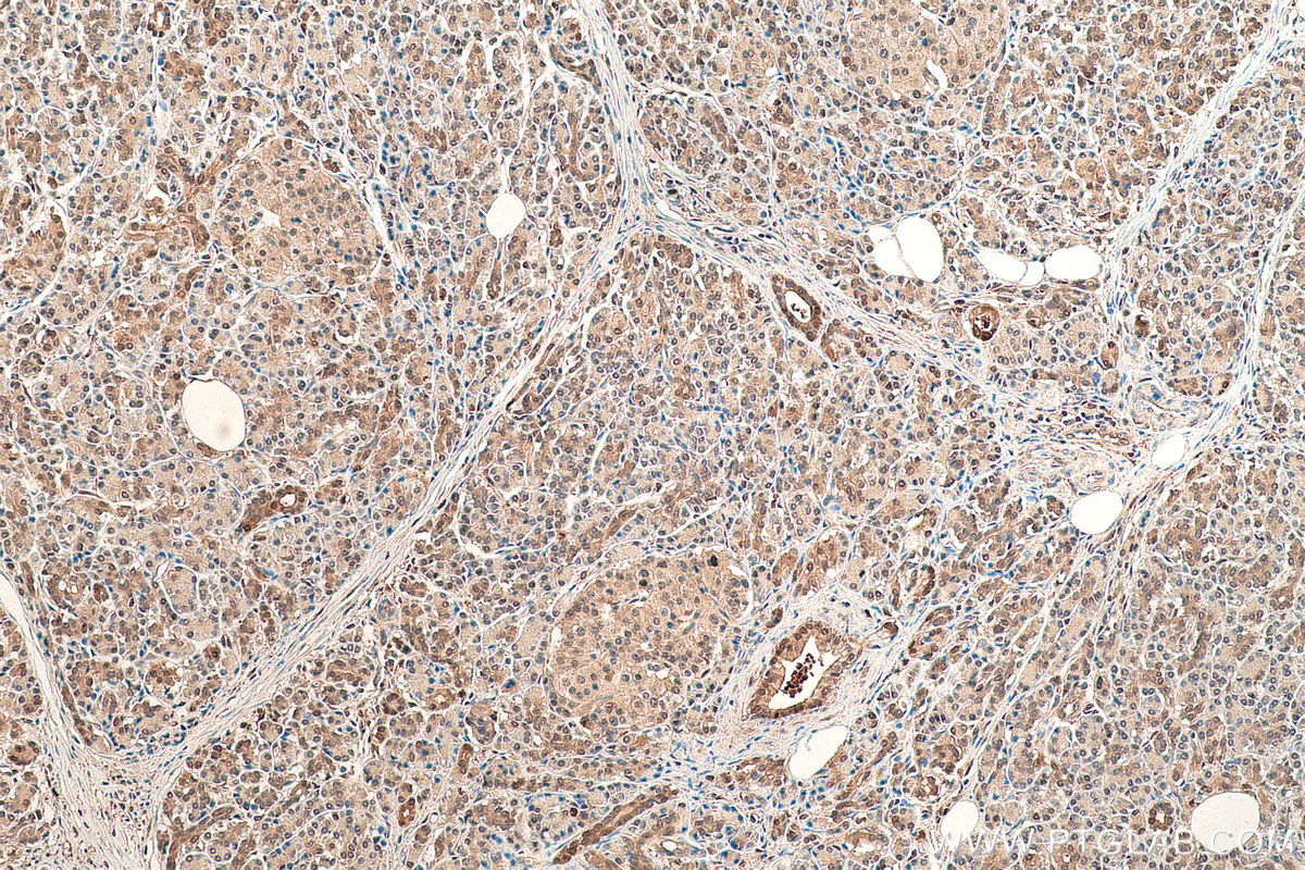 Immunohistochemical analysis of paraffin-embedded human pancreas cancer tissue slide using KHC0864 (PDXK IHC Kit).