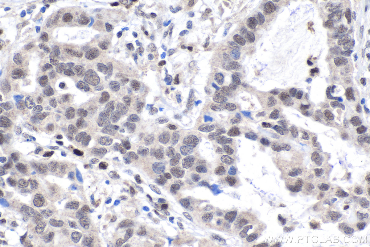 Immunohistochemical analysis of paraffin-embedded human lung cancer tissue slide using KHC1806 (PEG10 IHC Kit).