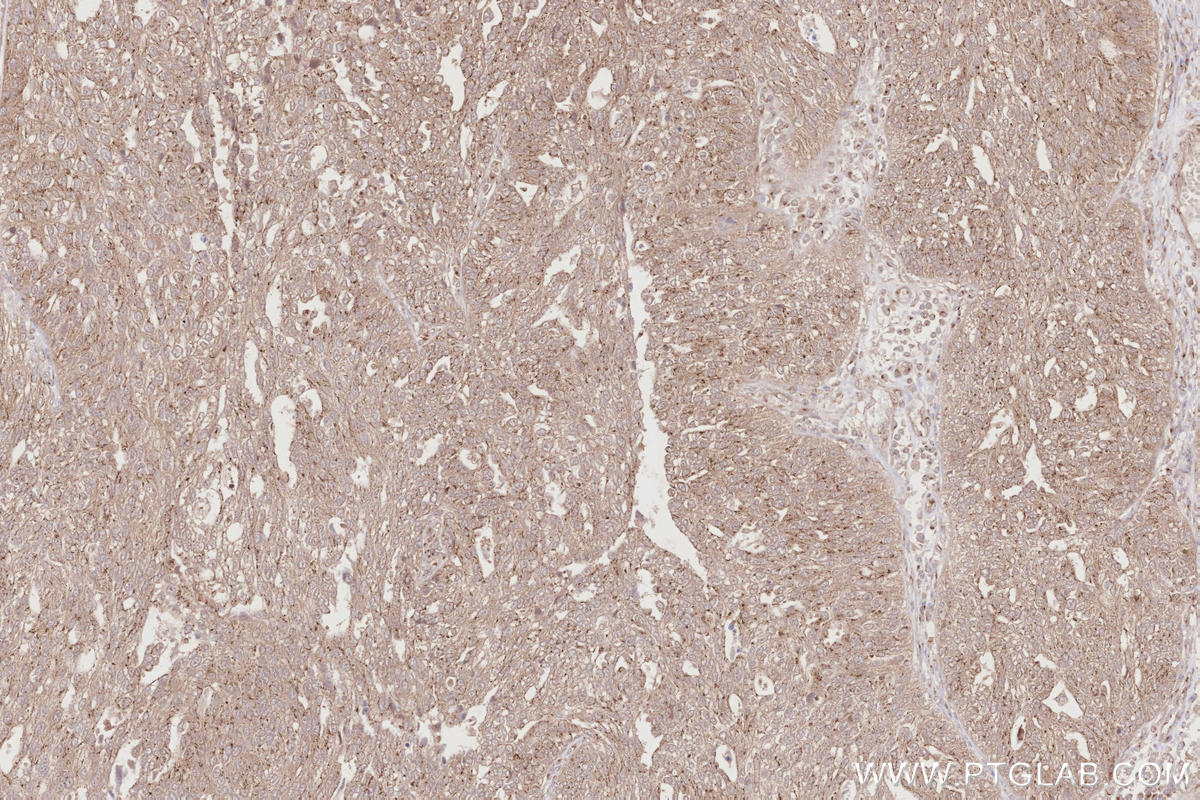 Immunohistochemical analysis of paraffin-embedded human ovary cancer tissue slide using KHC2859 (PELO IHC Kit).
