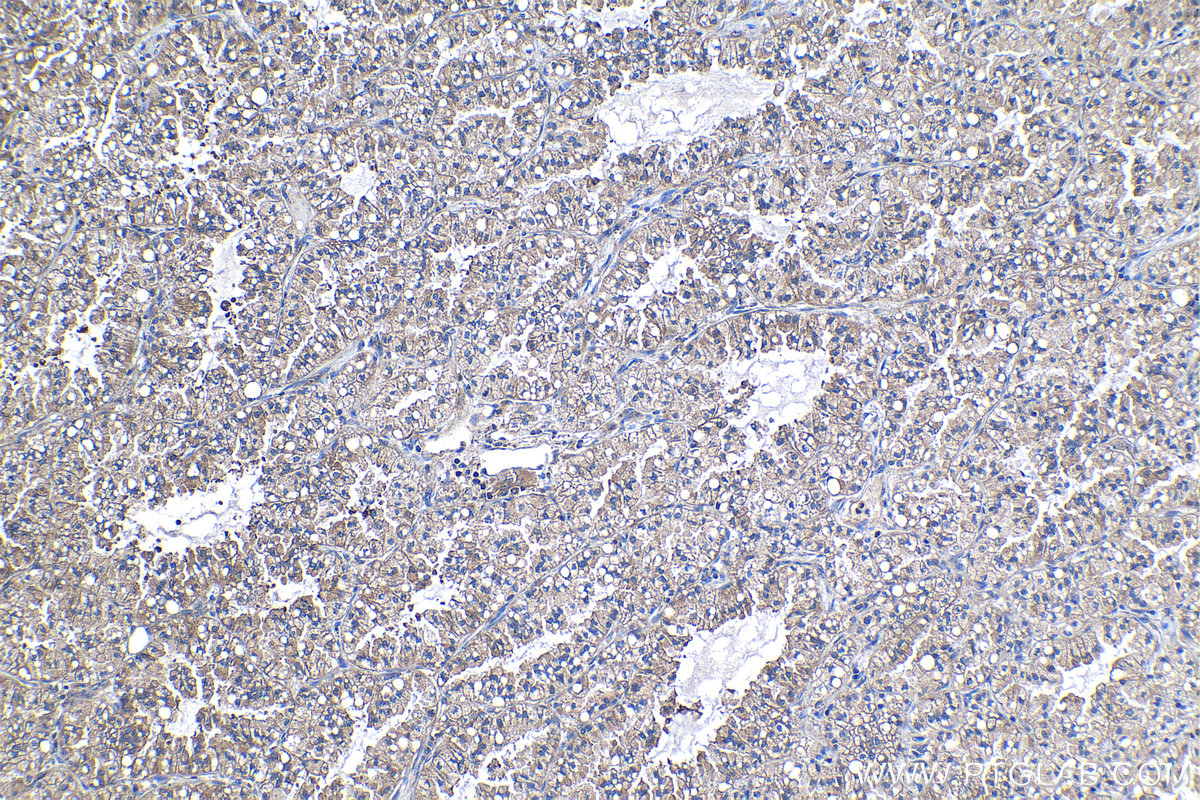 Immunohistochemical analysis of paraffin-embedded human lung cancer tissue slide using KHC1278 (PFKL IHC Kit).