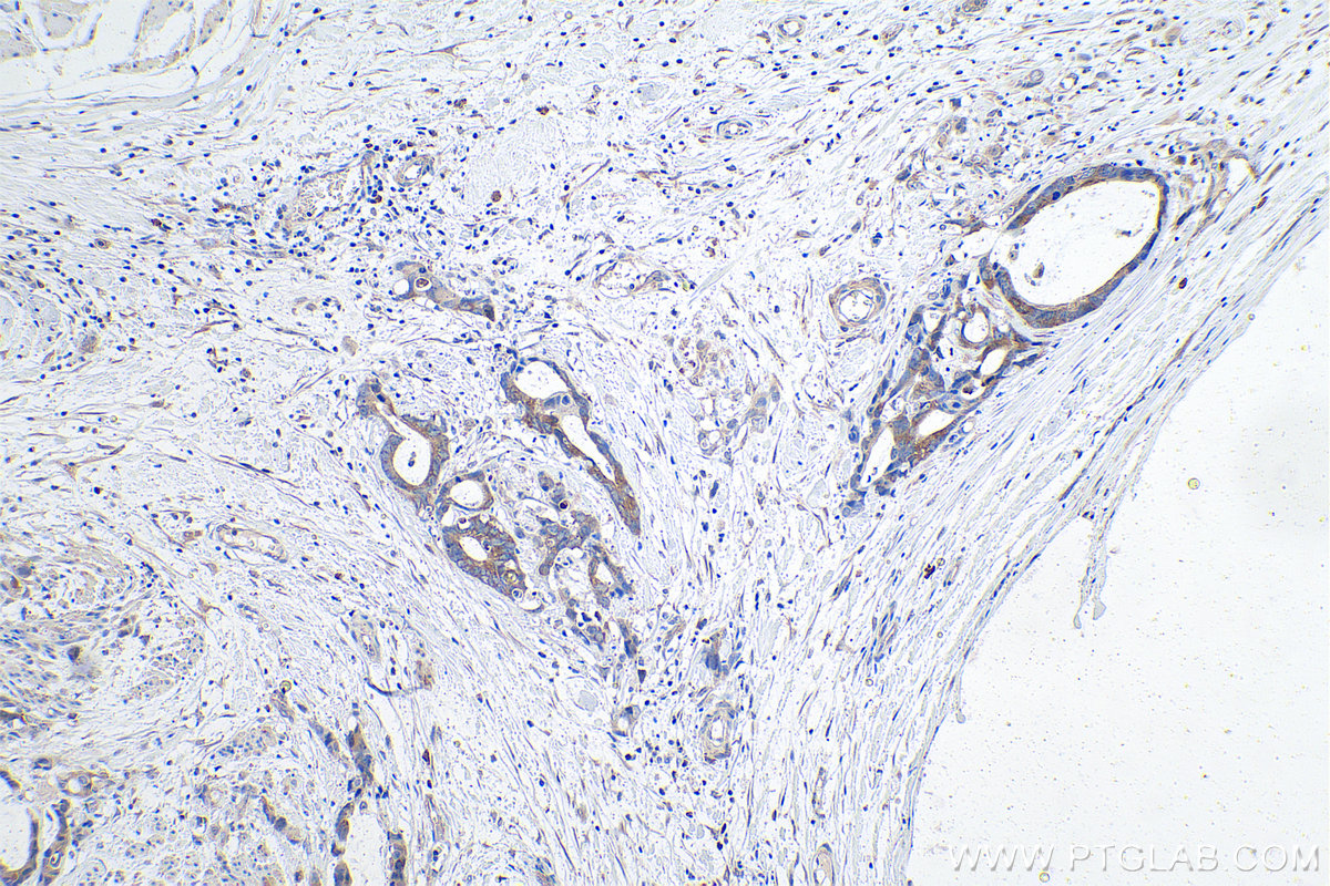 Immunohistochemical analysis of paraffin-embedded human urothelial carcinoma tissue slide using KHC1007 (PFKM IHC Kit).