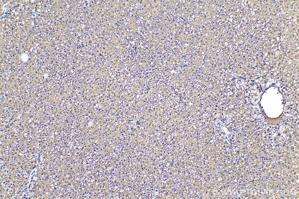 Immunohistochemical analysis of paraffin-embedded human liver cancer tissue slide using KHC0519 (PFN1 IHC Kit).