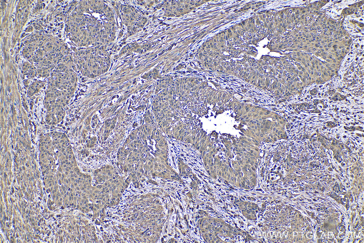 Immunohistochemical analysis of paraffin-embedded human urothelial carcinoma tissue slide using KHC0519 (PFN1 IHC Kit).