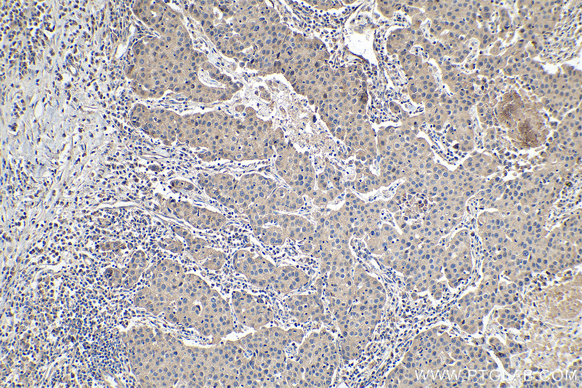 Immunohistochemical analysis of paraffin-embedded human breast cancer tissue slide using KHC0218 (Placental Growth Factor IHC Kit).