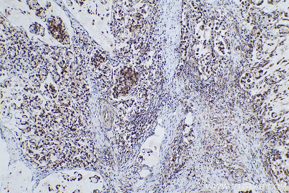 Immunohistochemical analysis of paraffin-embedded human colon cancer tissue slide using KHC0542 (PGK1 IHC Kit).