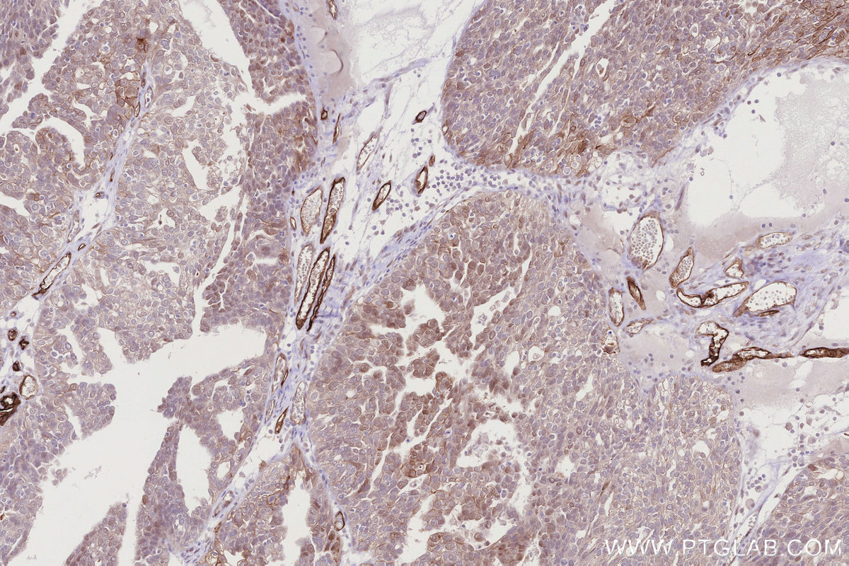 Immunohistochemical analysis of paraffin-embedded human ovary cancer tissue slide using KHC2768 (PGT IHC Kit).