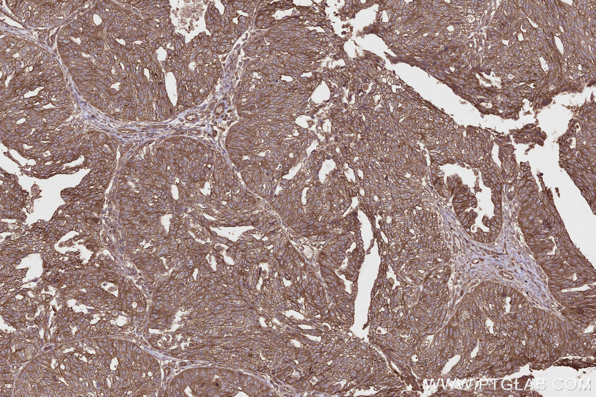 Immunohistochemical analysis of paraffin-embedded human ovary cancer tissue slide using KHC2662 (PHACTR4 IHC Kit).