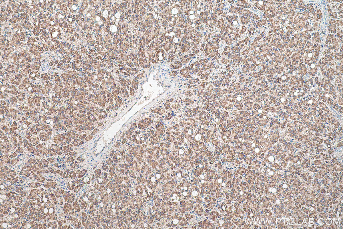 Immunohistochemical analysis of paraffin-embedded human liver cancer tissue slide using KHC0570 (PHB2 IHC Kit).