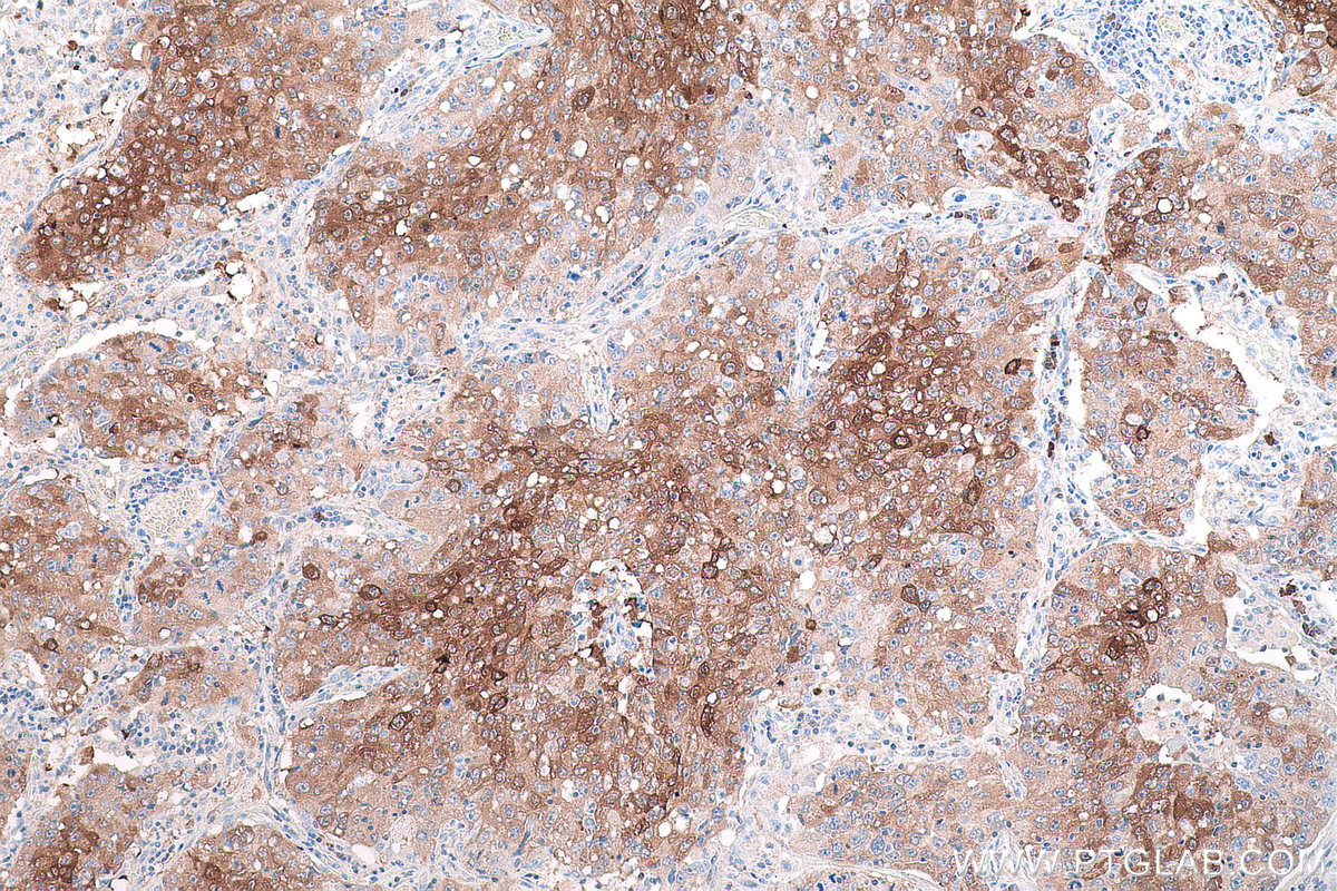 Immunohistochemical analysis of paraffin-embedded human lung cancer tissue slide using KHC0839 (PHGDH IHC Kit).