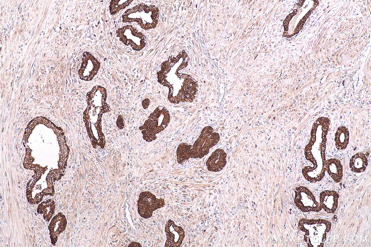 Immunohistochemical analysis of paraffin-embedded human prostate cancer tissue slide using KHC0839 (PHGDH IHC Kit).
