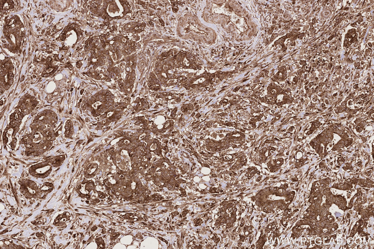 Immunohistochemical analysis of paraffin-embedded human rectal cancer tissue slide using KHC2772 (PHKB IHC Kit).