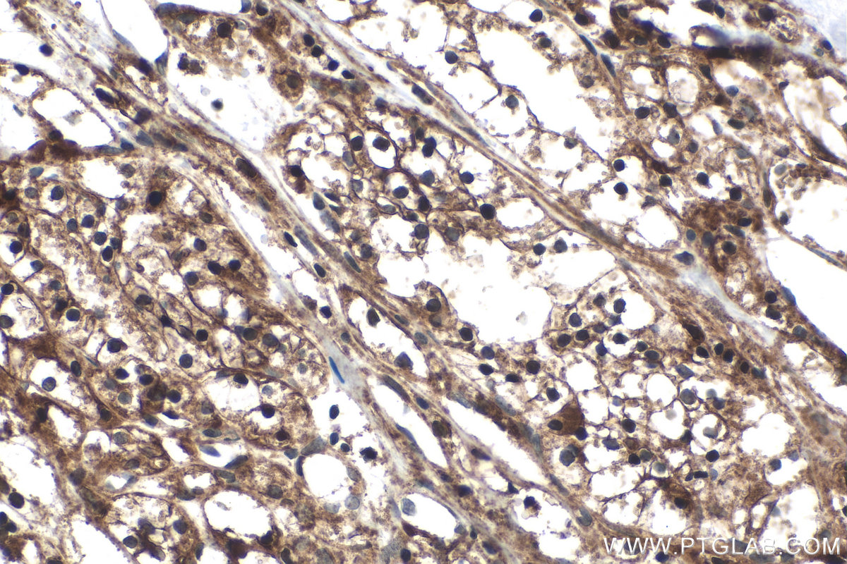 Immunohistochemical analysis of paraffin-embedded human renal cell carcinoma tissue slide using KHC0310 (PI16 IHC Kit).