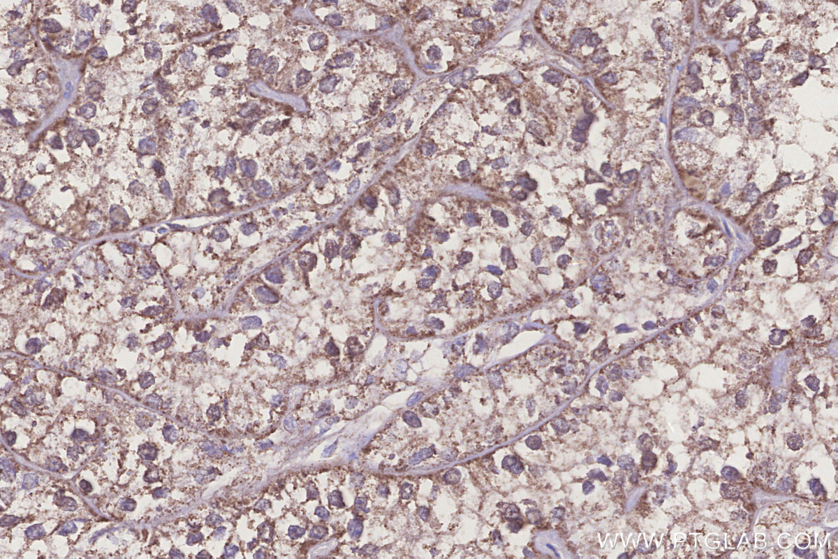 Immunohistochemical analysis of paraffin-embedded human renal cell carcinoma tissue slide using KHC3234 (PIGP IHC Kit).