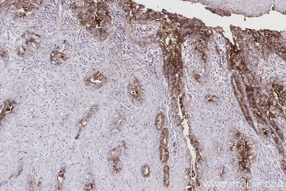 Immunohistochemical analysis of paraffin-embedded human pancreas cancer tissue slide using KHC3161 (PIGR IHC Kit).