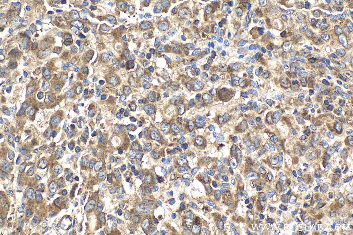 Immunohistochemical analysis of paraffin-embedded human stomach cancer tissue slide using KHC2044 (PIK3C2A IHC Kit).