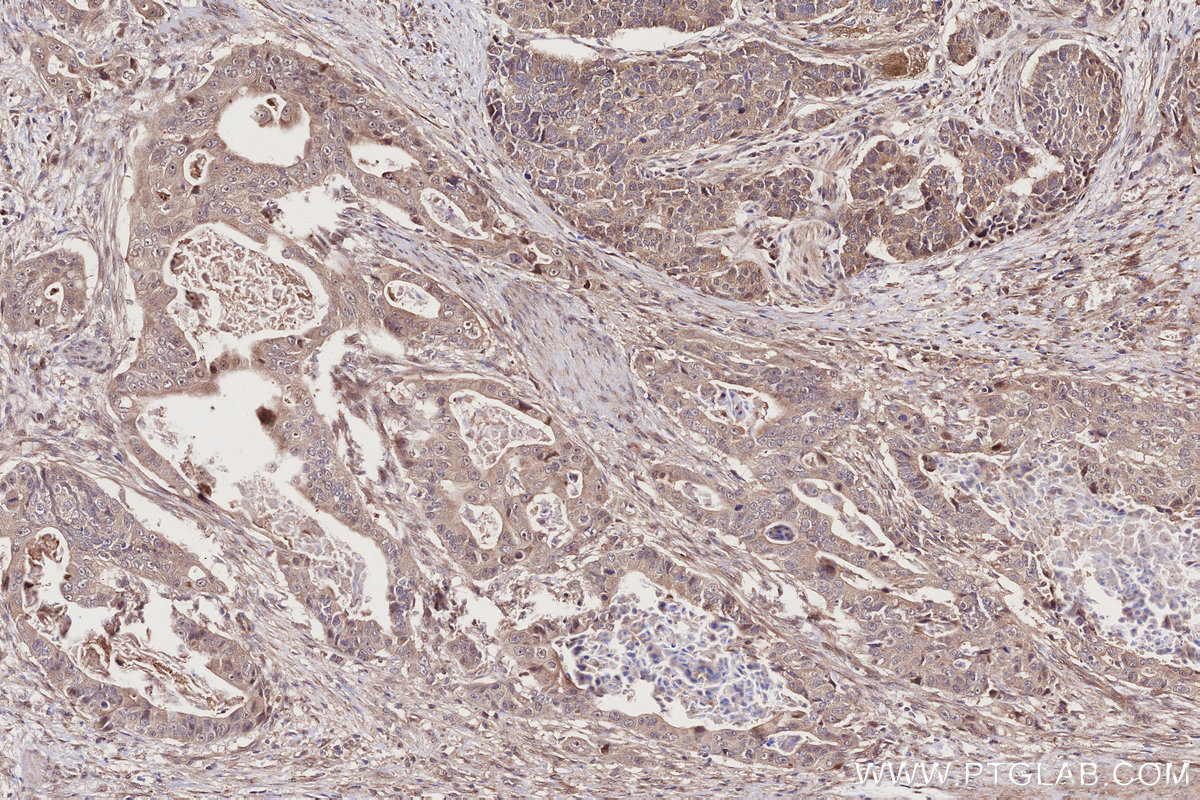Immunohistochemical analysis of paraffin-embedded human stomach cancer tissue slide using KHC2746 (PIK3R3 IHC Kit).