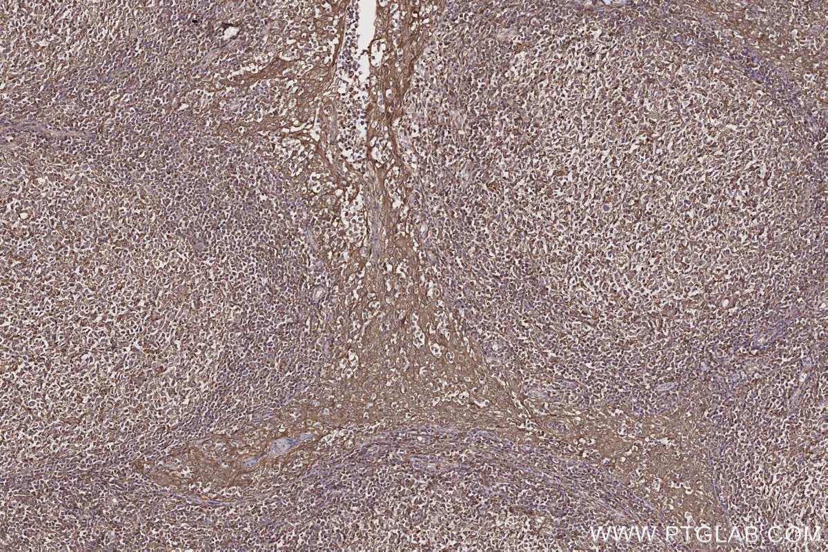 Immunohistochemical analysis of paraffin-embedded human tonsillitis tissue slide using KHC2709 (PIP4K2C IHC Kit).