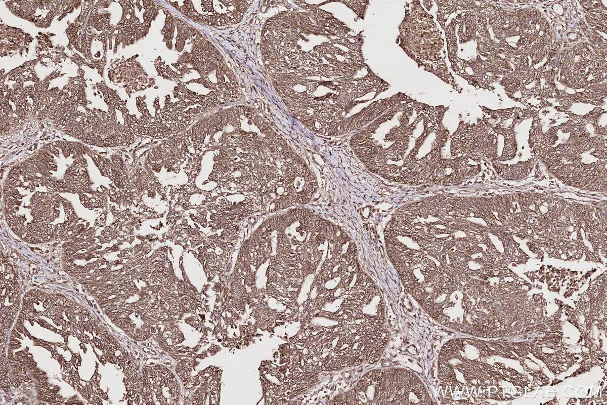 Immunohistochemical analysis of paraffin-embedded human ovary cancer tissue slide using KHC2709 (PIP4K2C IHC Kit).
