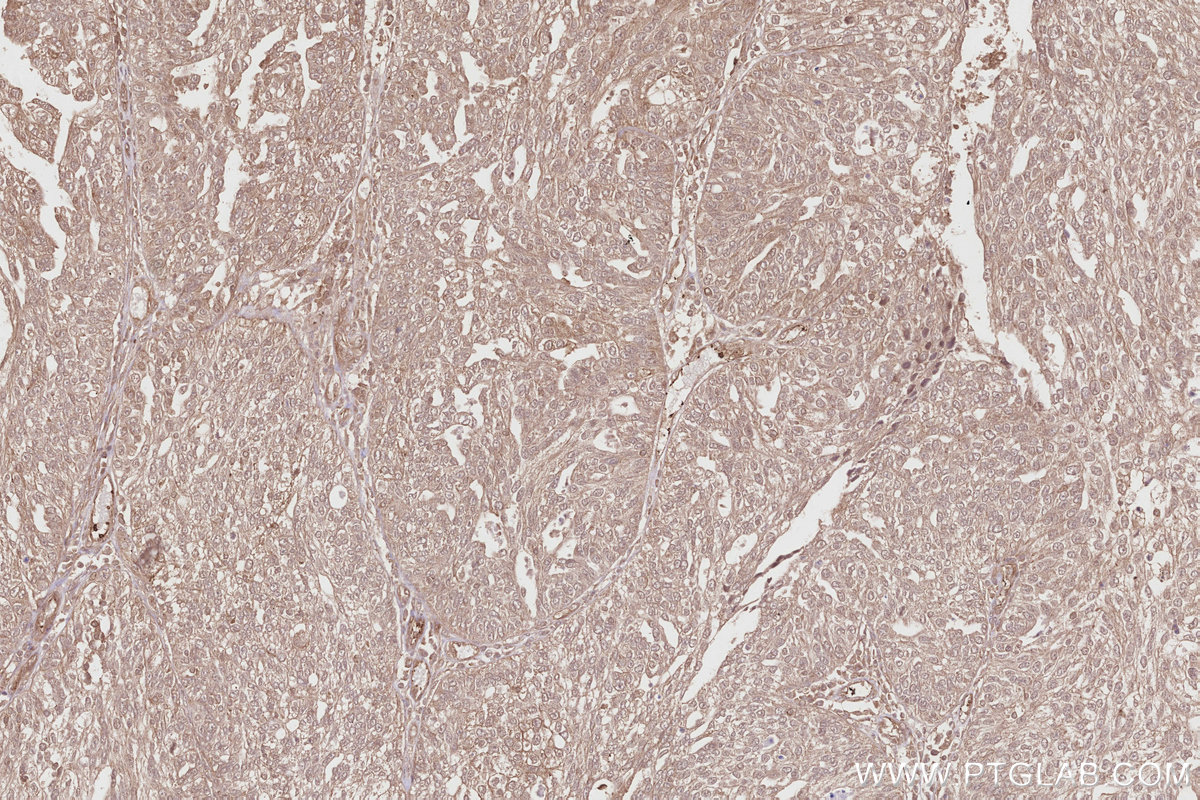 Immunohistochemical analysis of paraffin-embedded human ovary cancer tissue slide using KHC2848 (PIP5K1A IHC Kit).