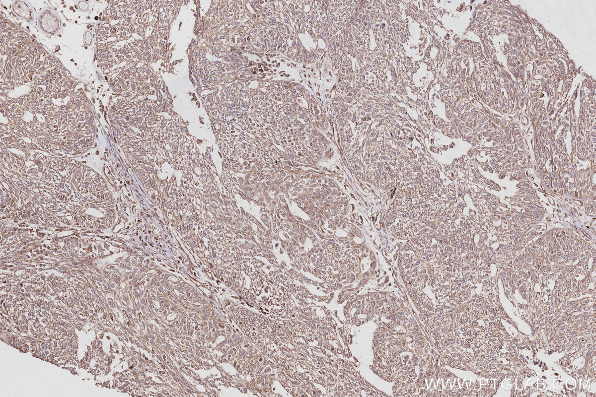 Immunohistochemical analysis of paraffin-embedded human ovary cancer tissue slide using KHC3054 (PIP5K3 IHC Kit). Immunohistochemical analysis of paraffin-embedded human ovary cancer tissue slide using KHC3054 (PIP5K3 IHC Kit).