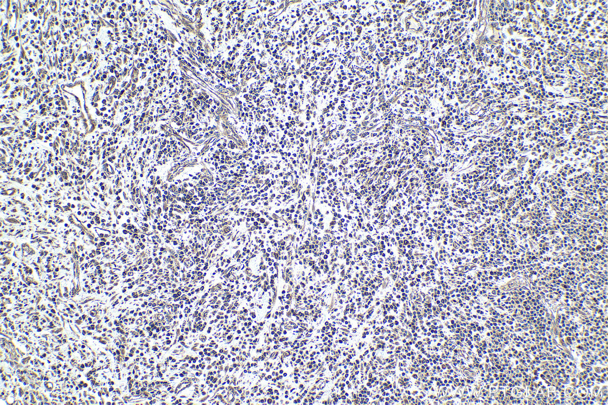 Immunohistochemical analysis of paraffin-embedded human colon cancer tissue slide using KHC0984 (PITPNA IHC Kit).