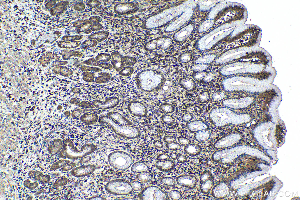 Immunohistochemical analysis of paraffin-embedded human stomach cancer tissue slide using KHC0984 (PITPNA IHC Kit).