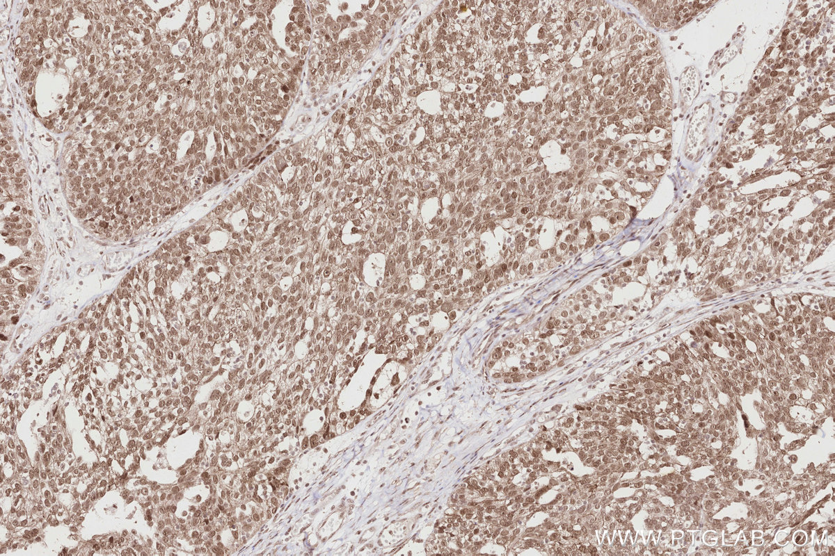 Immunohistochemical analysis of paraffin-embedded human ovary cancer tissue slide using KHC2851 (PKP2 IHC Kit).