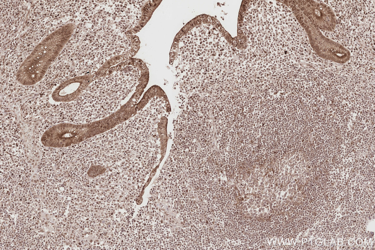 Immunohistochemical analysis of paraffin-embedded human appendicitis tissue slide using KHC2851 (PKP2 IHC Kit).