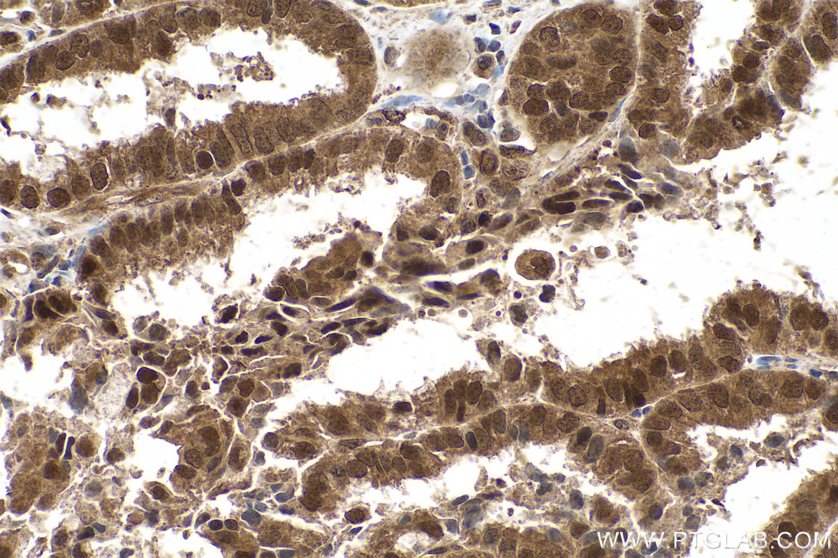 Immunohistochemical analysis of paraffin-embedded human ovary tumor tissue slide using KHC0774 (PLAA IHC Kit).