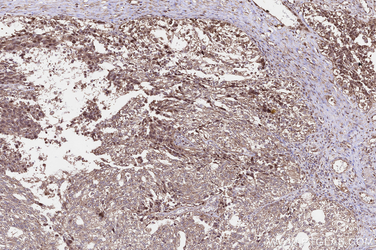 Immunohistochemical analysis of paraffin-embedded human ovary cancer tissue slide using KHC3227 (PLAAT3 IHC Kit).