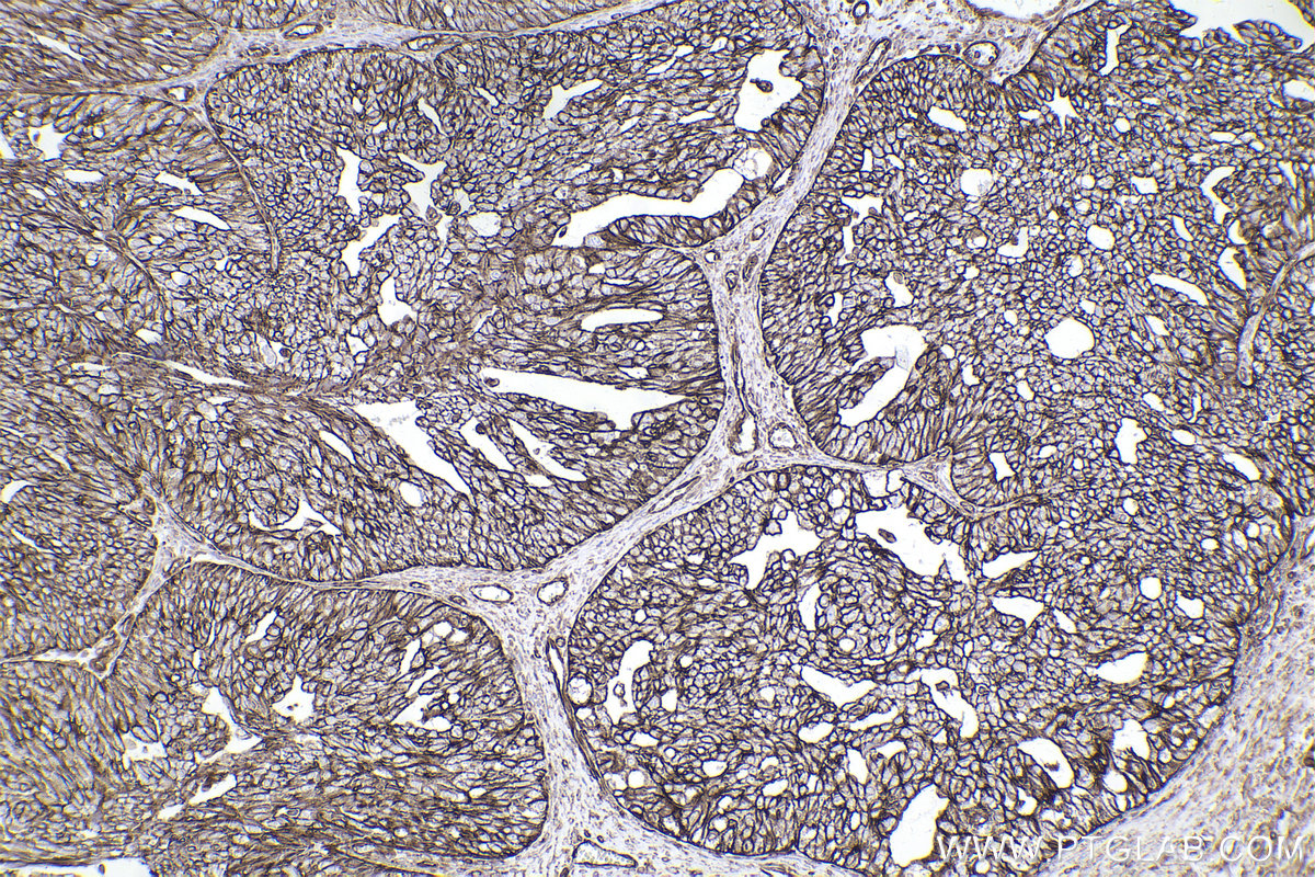 Immunohistochemical analysis of paraffin-embedded human ovary cancer tissue slide using KHC2482 (PLEC IHC Kit).