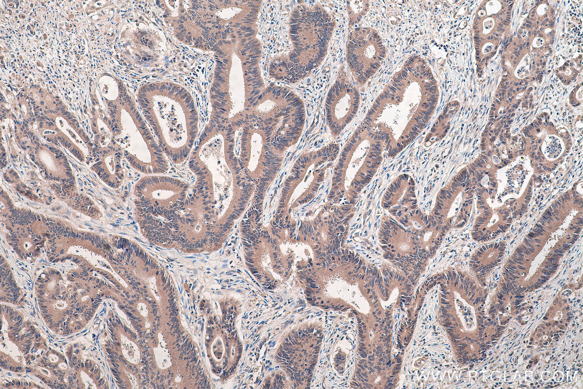 Immunohistochemical analysis of paraffin-embedded human colon cancer tissue slide using KHC0445 (PLEK2 IHC Kit).