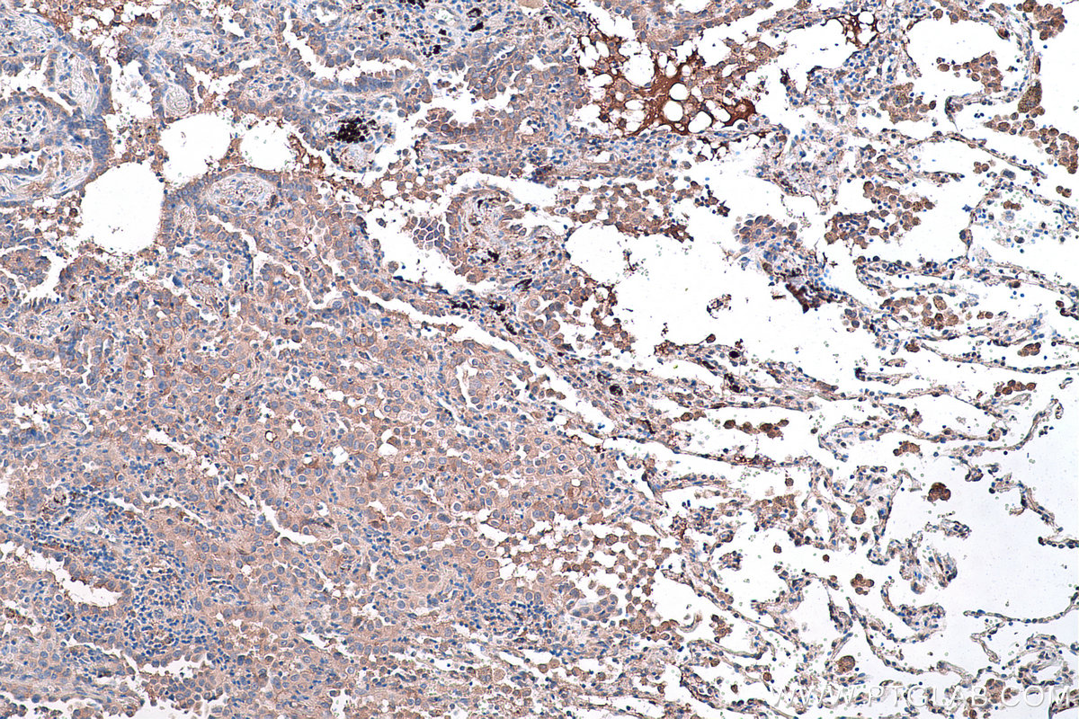 Immunohistochemical analysis of paraffin-embedded human lung cancer tissue slide using KHC0445 (PLEK2 IHC Kit).