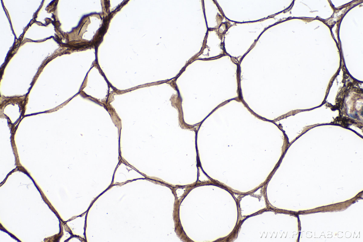 Immunohistochemical analysis of paraffin-embedded human prostate cancer tissue slide using KHC0228 (PLIN1 IHC Kit).