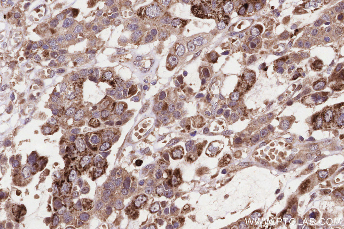 Immunohistochemical analysis of paraffin-embedded human stomach cancer tissue slide using KHC3229 (PLTP IHC Kit).