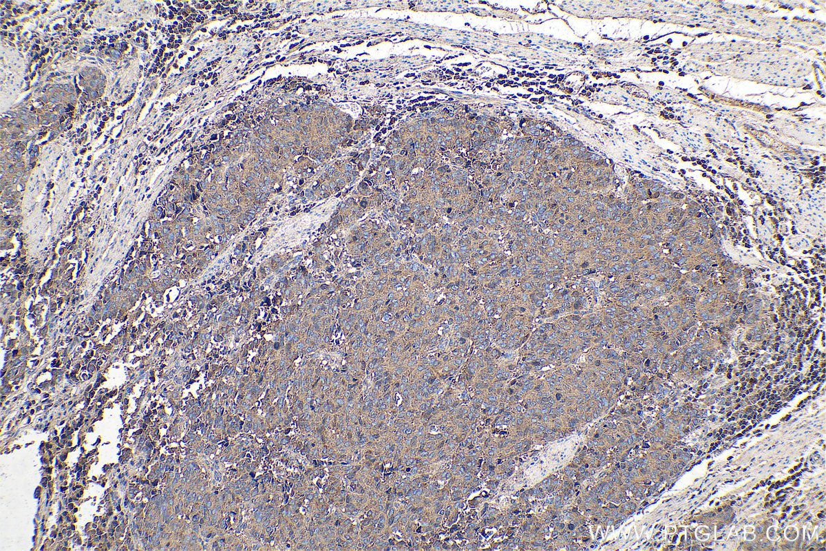 Immunohistochemical analysis of paraffin-embedded human stomach cancer tissue slide using KHC0760 (PMEPA1 IHC Kit).
