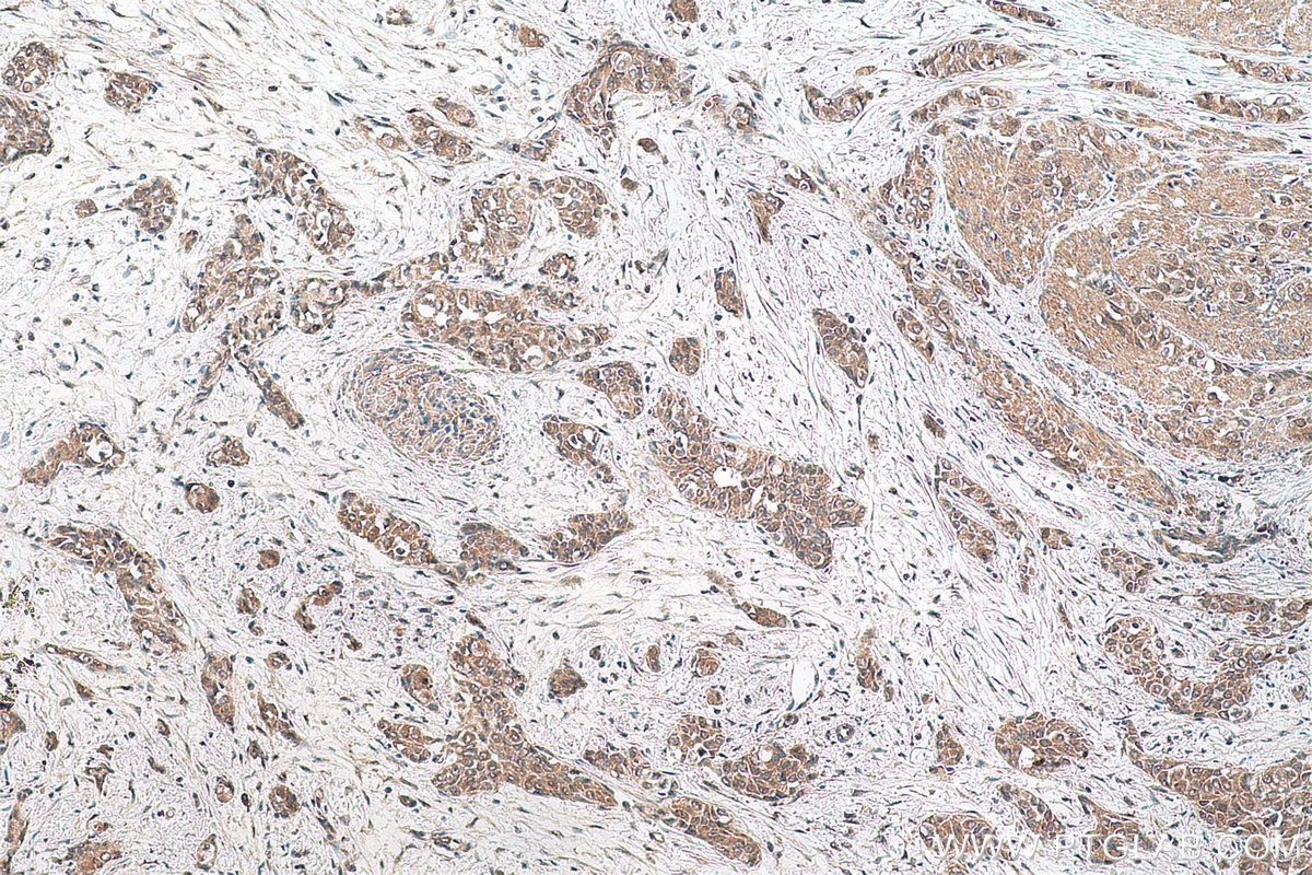 Immunohistochemical analysis of paraffin-embedded human urothelial carcinoma tissue slide using KHC0760 (PMEPA1 IHC Kit).