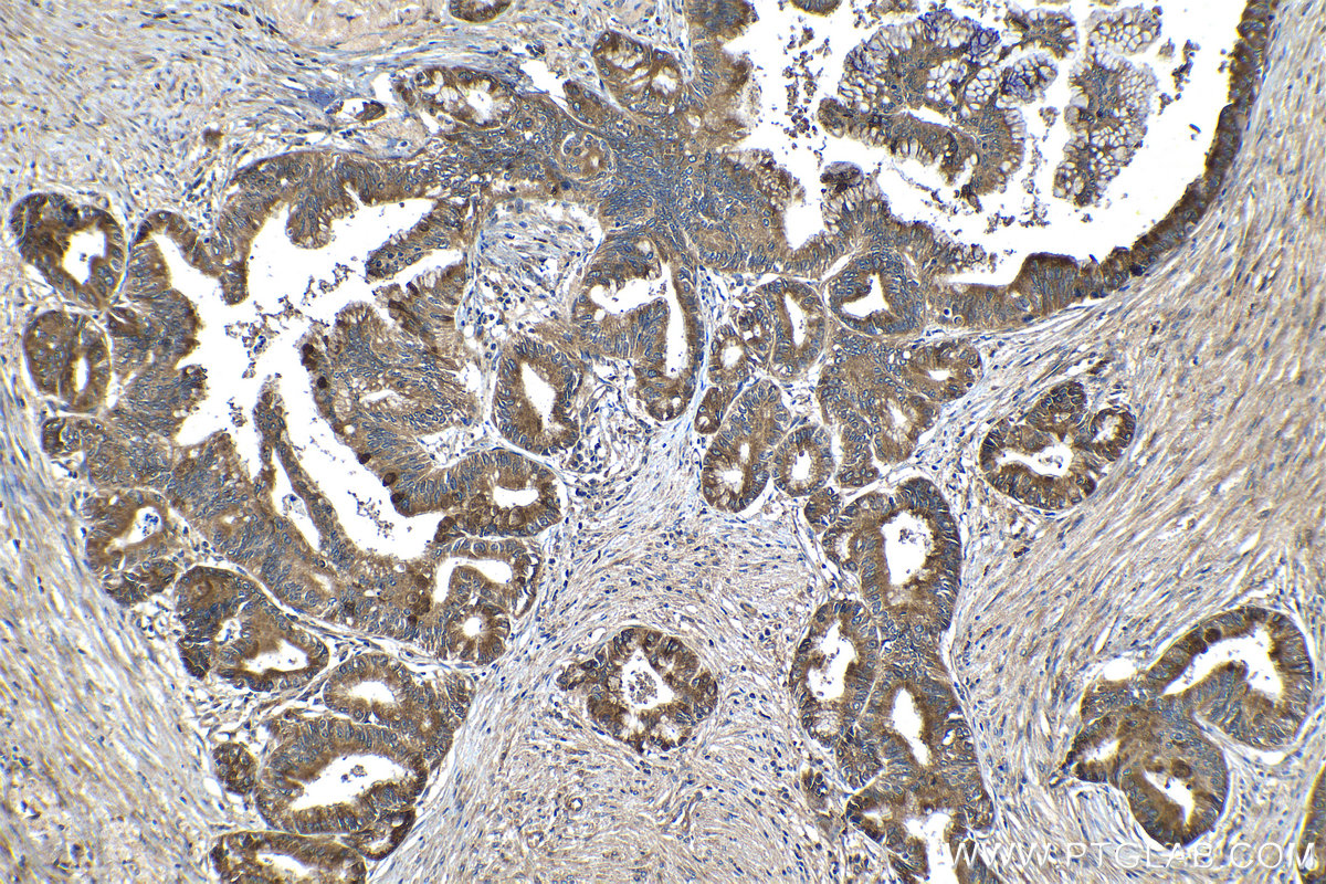 Immunohistochemical analysis of paraffin-embedded human pancreas cancer tissue slide using KHC1332 (PNLIP IHC Kit).