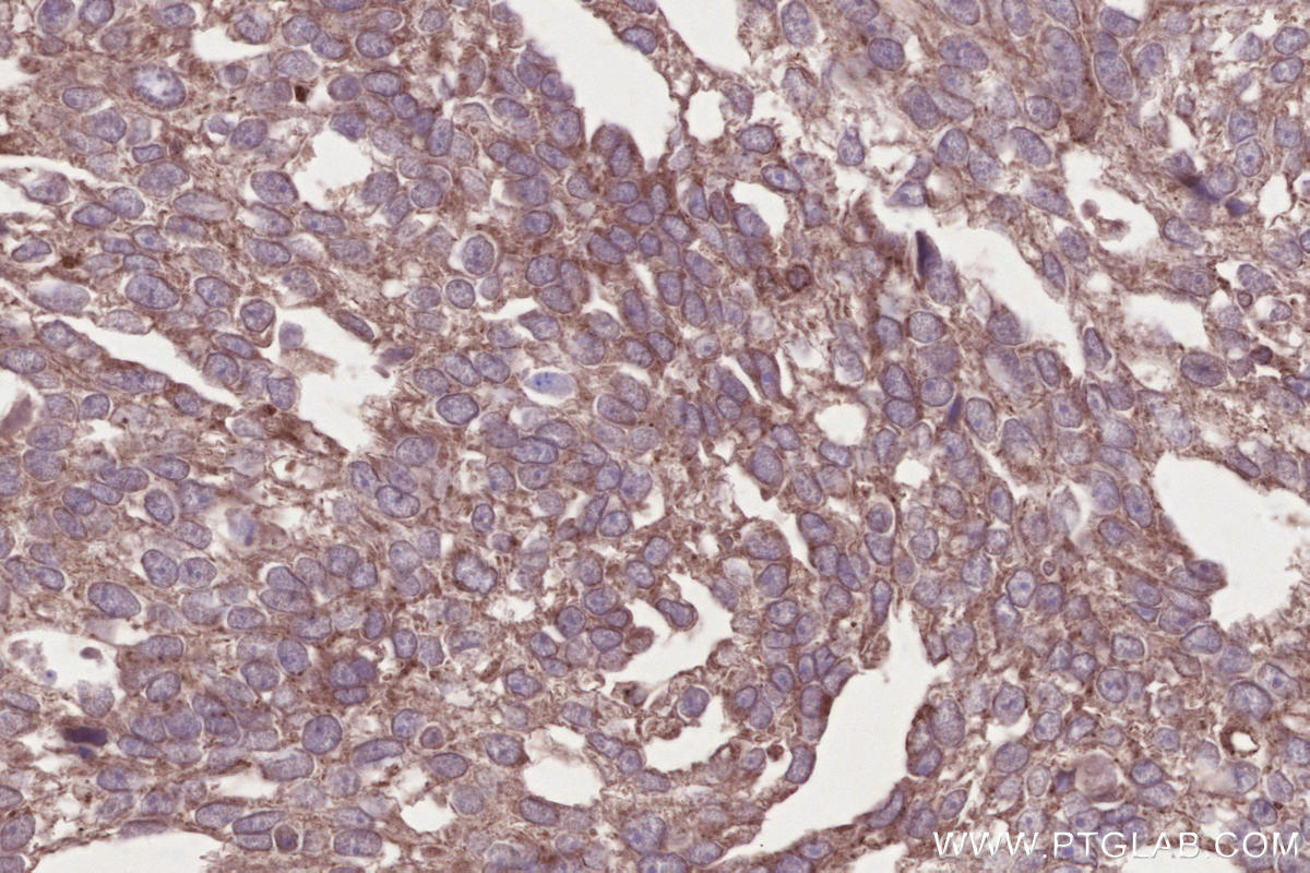 Immunohistochemical analysis of paraffin-embedded human ovary cancer tissue slide using KHC2655 (PNPLA6 IHC Kit).