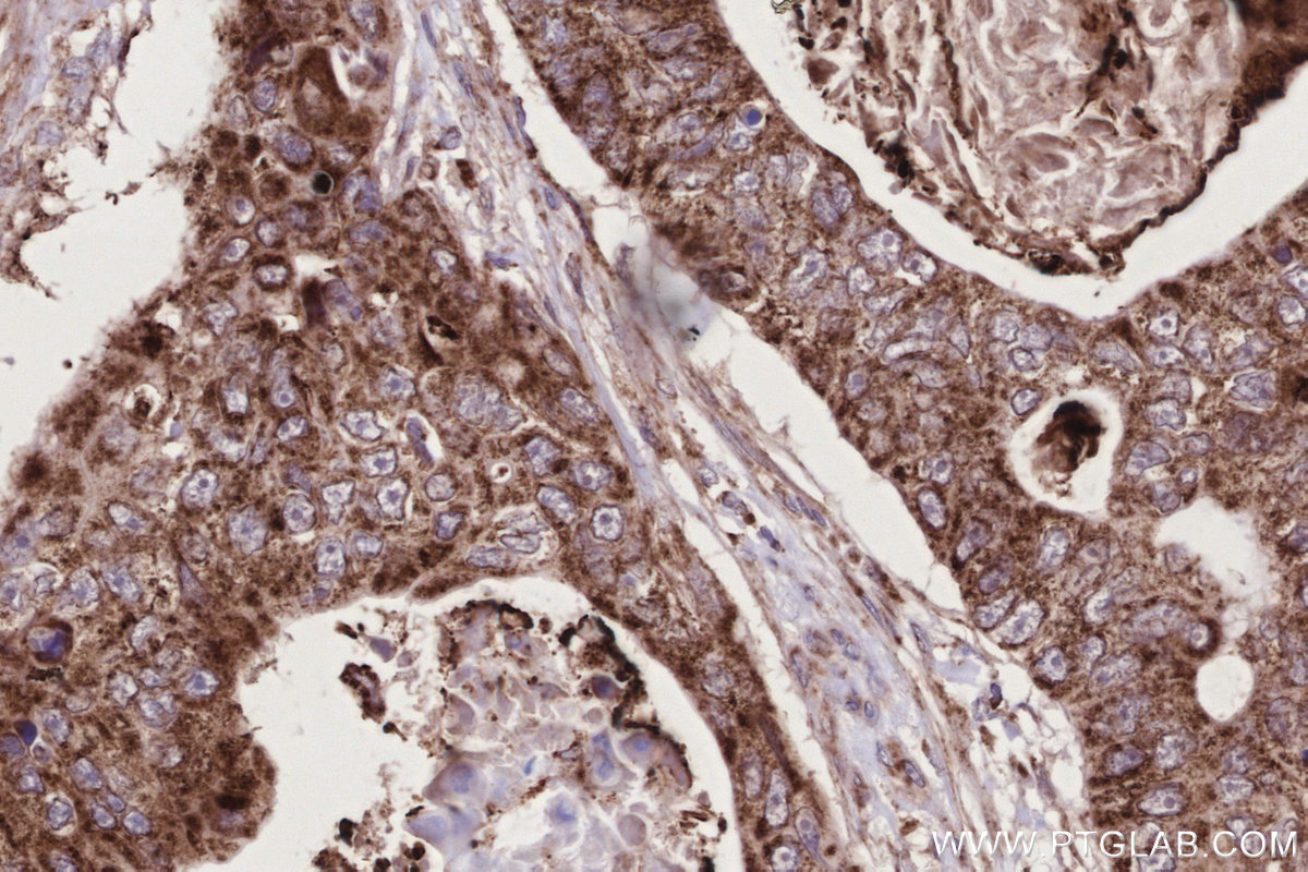 Immunohistochemical analysis of paraffin-embedded human stomach cancer tissue slide using KHC2713 (PNPT1 IHC Kit).