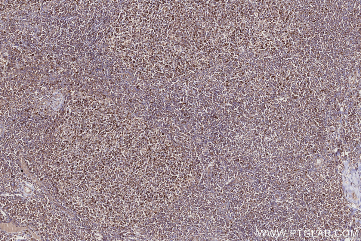 Immunohistochemical analysis of paraffin-embedded human tonsillitis tissue slide using KHC2713 (PNPT1 IHC Kit).