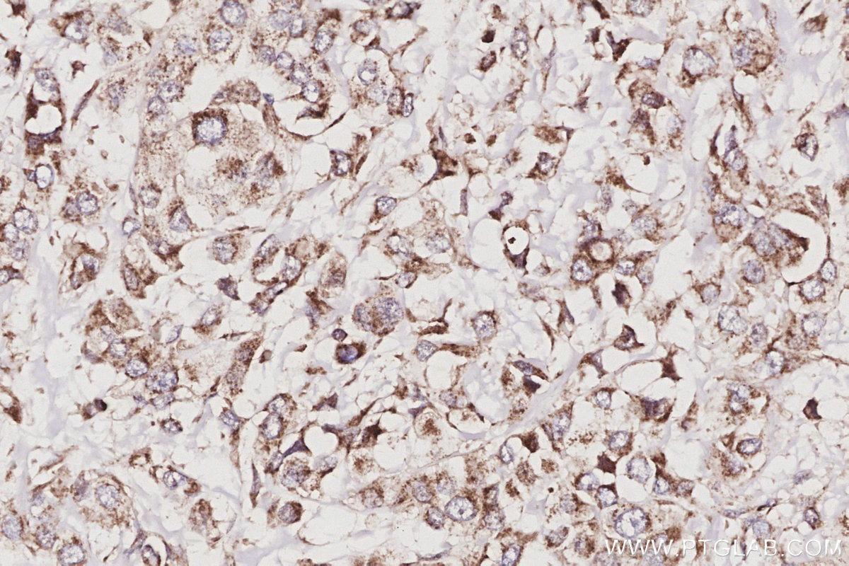 Immunohistochemical analysis of paraffin-embedded human breast cancer tissue slide using KHC3057 (POLDIP2 IHC Kit). Immunohistochemical analysis of paraffin-embedded human breast cancer tissue slide using KHC3057 (POLDIP2 IHC Kit).