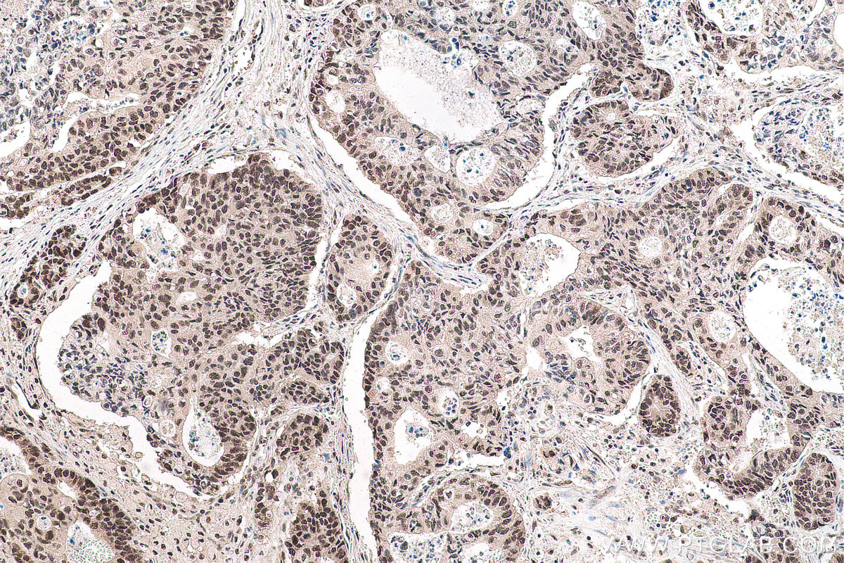 Immunohistochemical analysis of paraffin-embedded human stomach cancer tissue slide using KHC0929 (POLR2E/RPB5 IHC Kit).