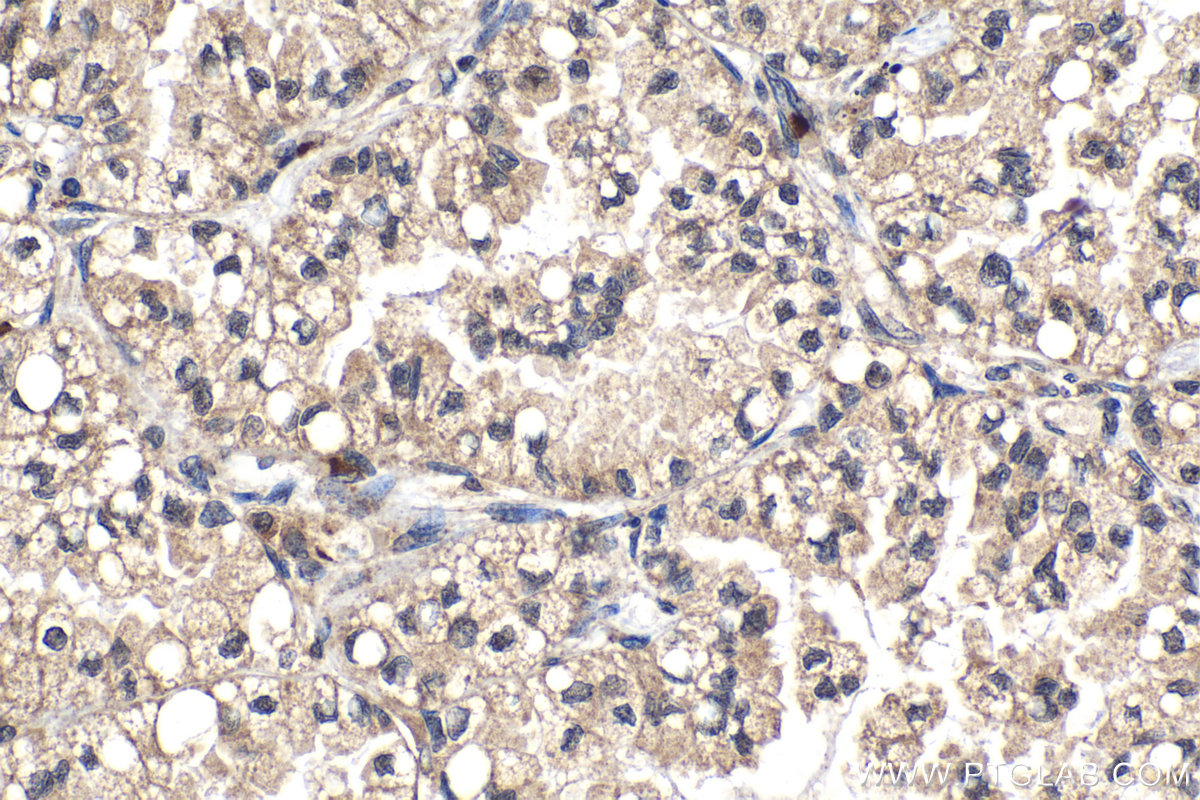 Immunohistochemical analysis of paraffin-embedded human lung cancer tissue slide using KHC2071 (POLR3G IHC Kit).