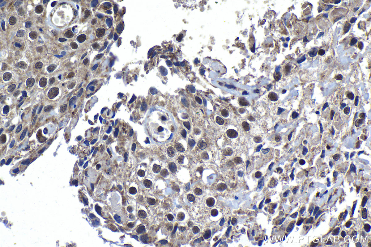 Immunohistochemical analysis of paraffin-embedded human cervical cancer tissue slide using KHC1193 (PPAN IHC Kit).