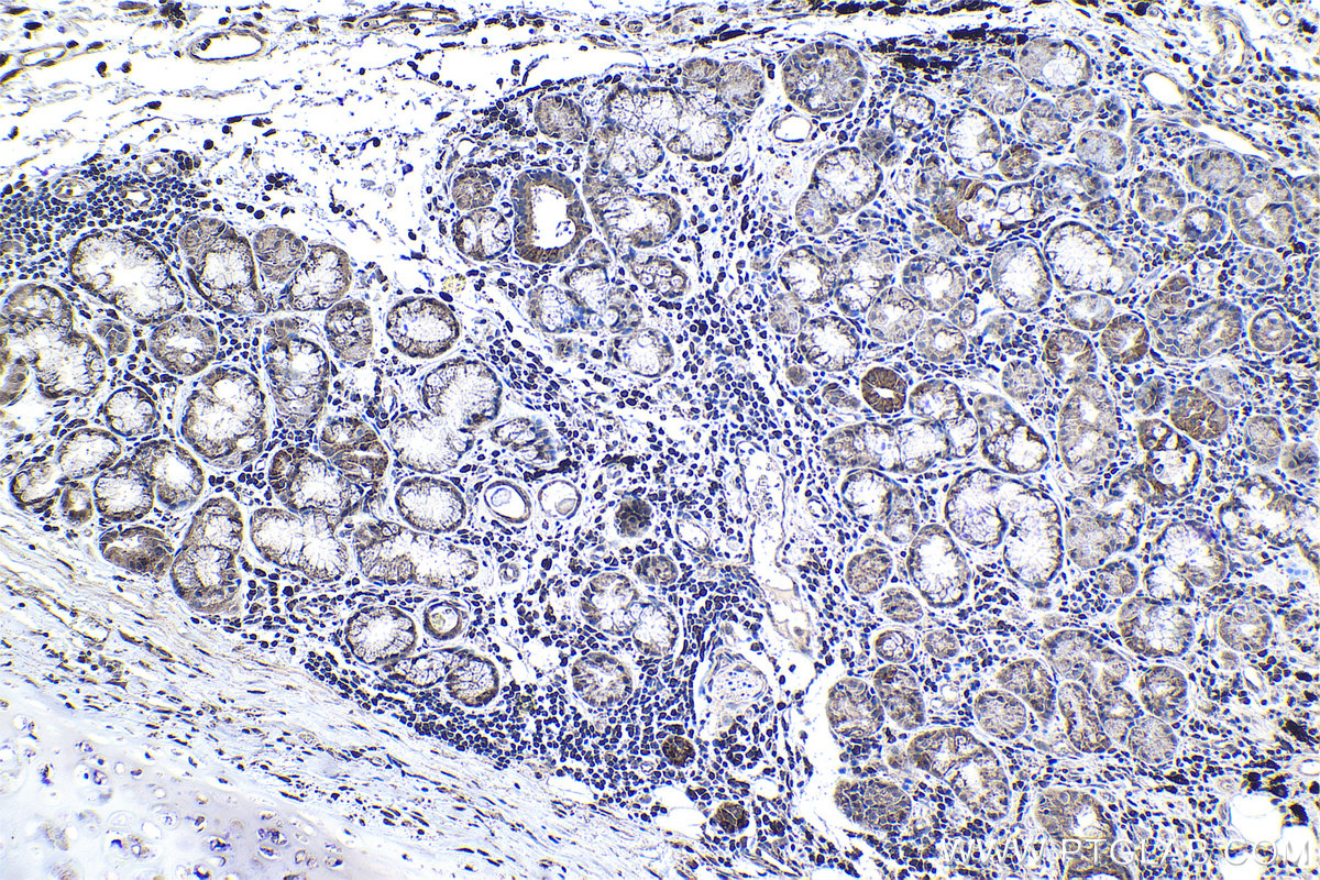 Immunohistochemical analysis of paraffin-embedded human lung cancer tissue slide using KHC1193 (PPAN IHC Kit).