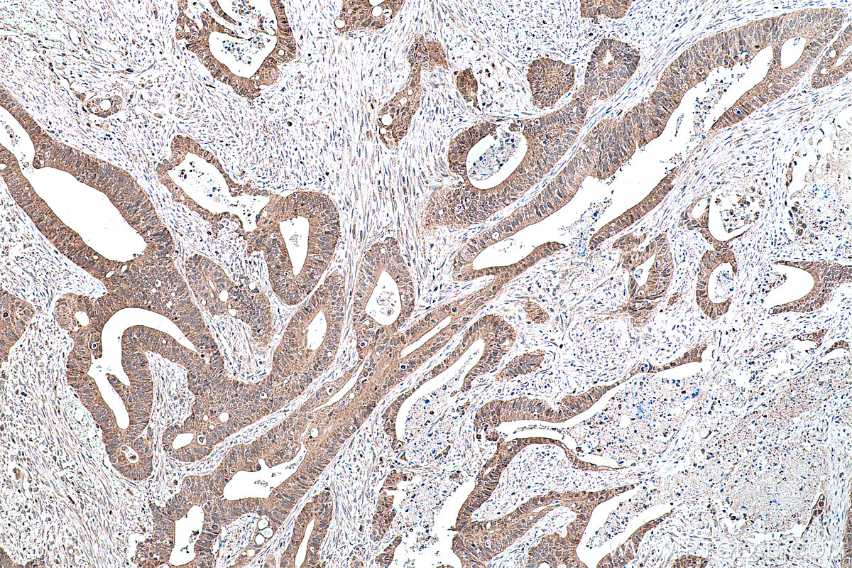 Immunohistochemical analysis of paraffin-embedded human colon cancer tissue slide using KHC0249 (PPARG IHC Kit).