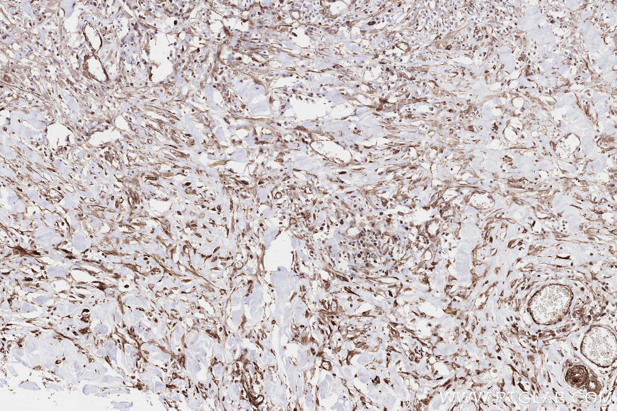 Immunohistochemical analysis of paraffin-embedded human colon cancer tissue slide using KHC3247 (PPAT IHC Kit). Immunohistochemical analysis of paraffin-embedded human colon cancer tissue slide using KHC3247 (PPAT IHC Kit).