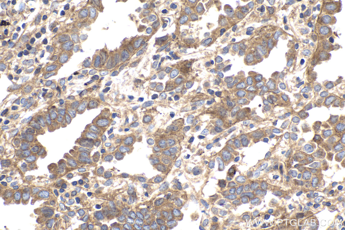 Immunohistochemical analysis of paraffin-embedded human lung cancer tissue slide using KHC1703 (PPFIA1 IHC Kit).